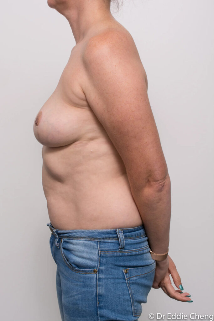 Before and after breast augmentation by Dr Eddie Cheng, Brisbane