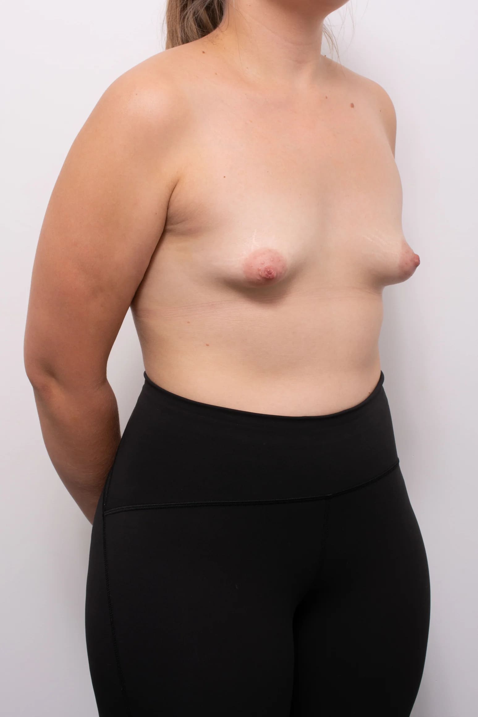Before and after breast surgery by Dr Eddie Cheng, Brisbane
