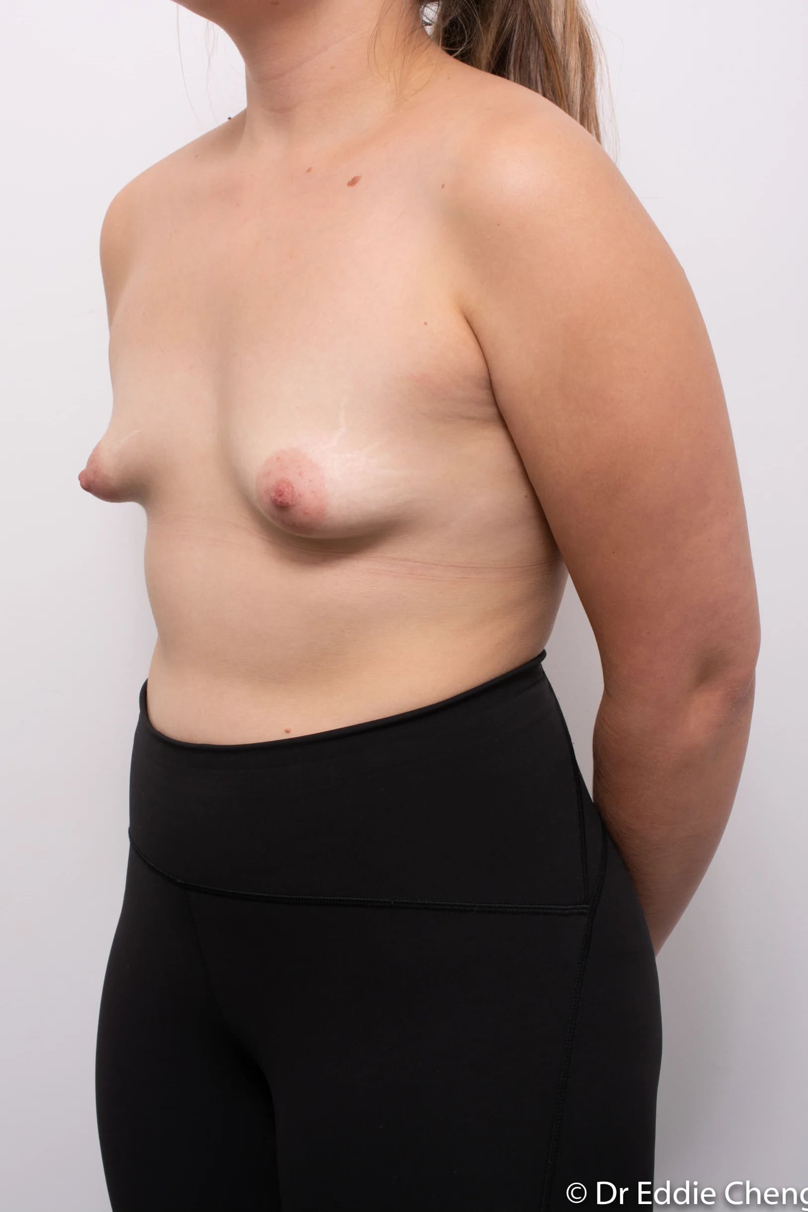 Before and after breast surgery by Dr Eddie Cheng, Brisbane