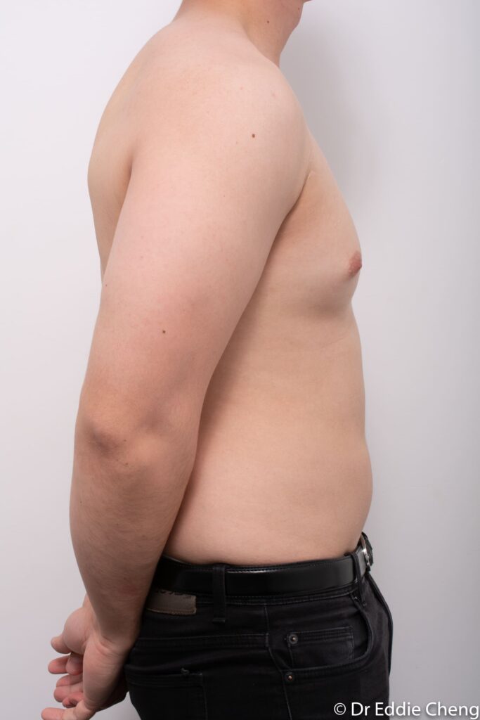 Before and after gynaecomastia surgery by Dr Eddie Cheng, Brisbane