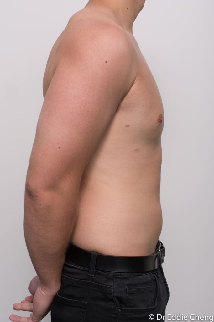 Before and after gynaecomastia surgery by Dr Eddie Cheng, Brisbane