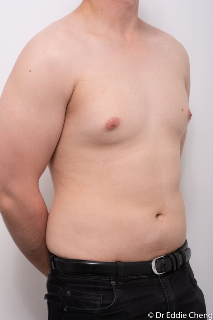Before and after gynaecomastia surgery by Dr Eddie Cheng, Brisbane
