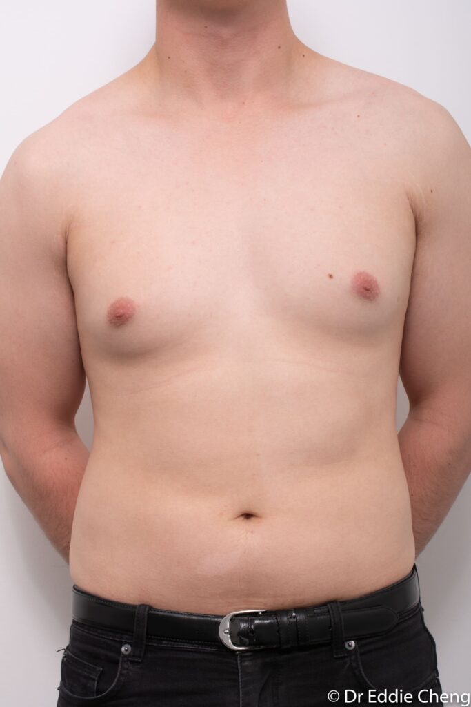 Before and after gynaecomastia surgery by Dr Eddie Cheng, Brisbane