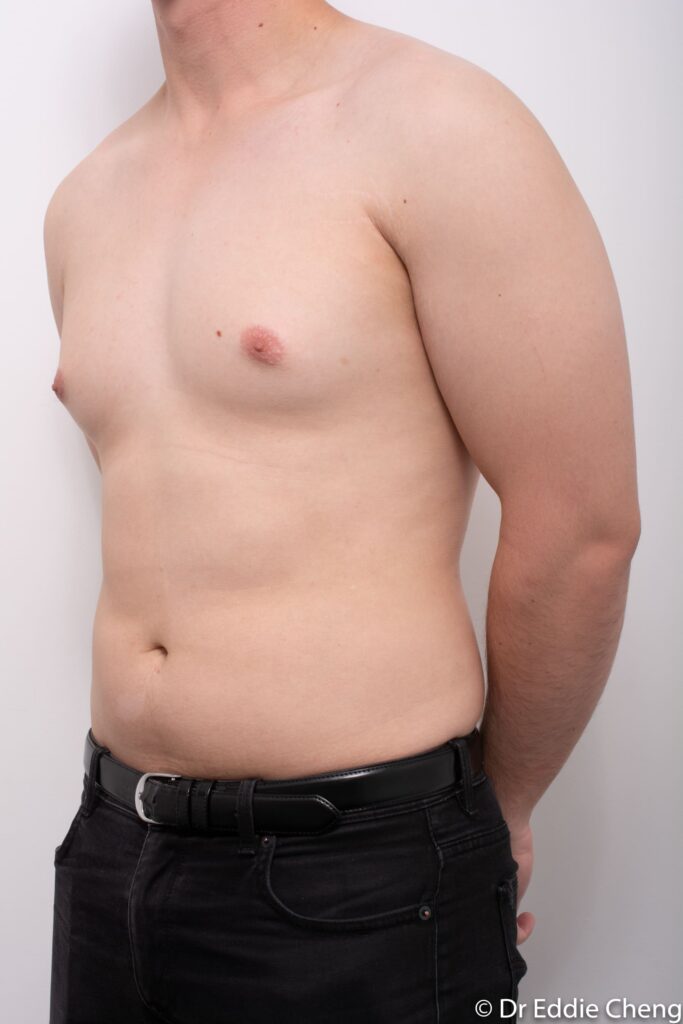 Before and after gynaecomastia surgery by Dr Eddie Cheng, Brisbane