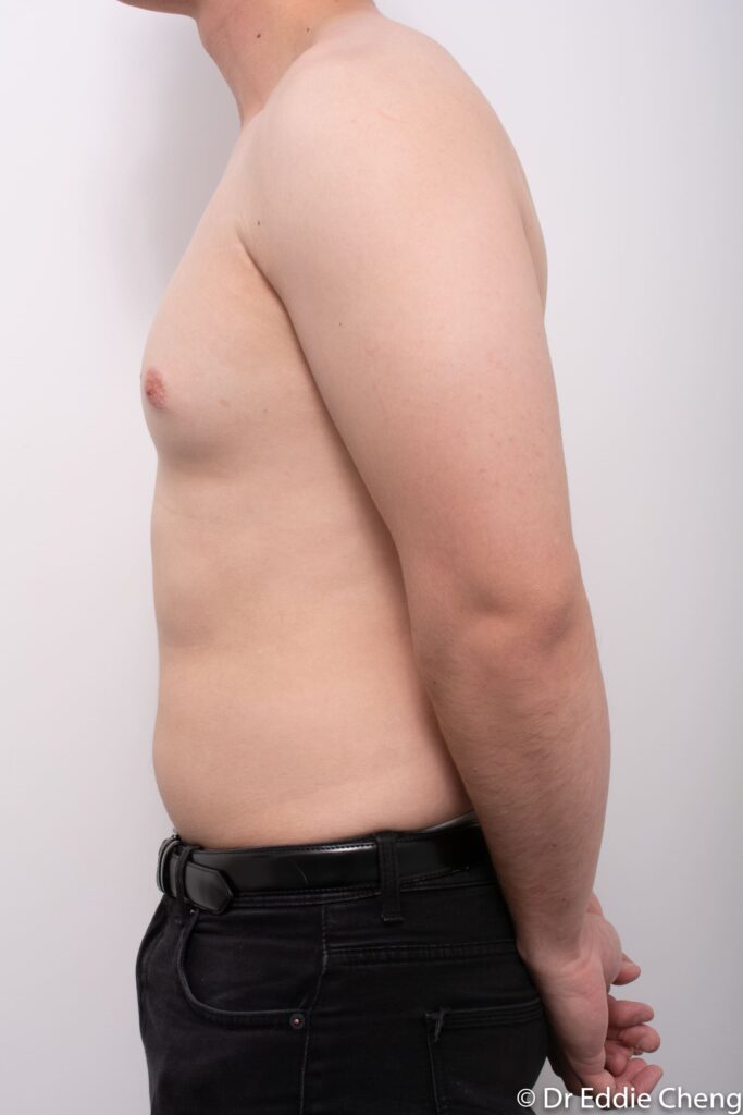 Before and after gynaecomastia surgery by Dr Eddie Cheng, Brisbane