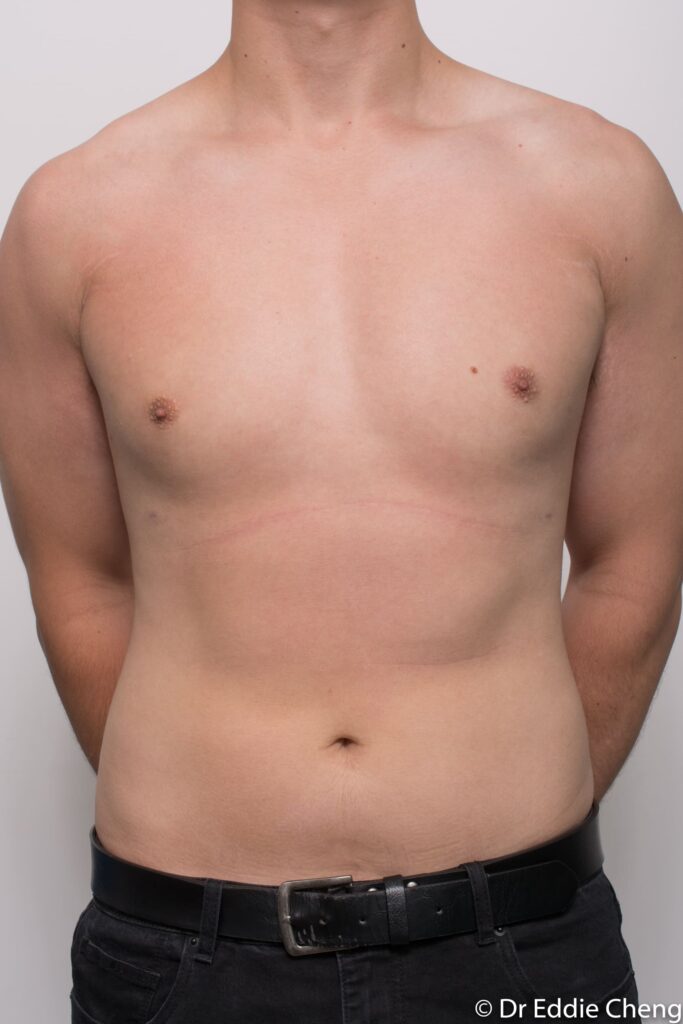 Before and after gynaecomastia surgery by Dr Eddie Cheng, Brisbane