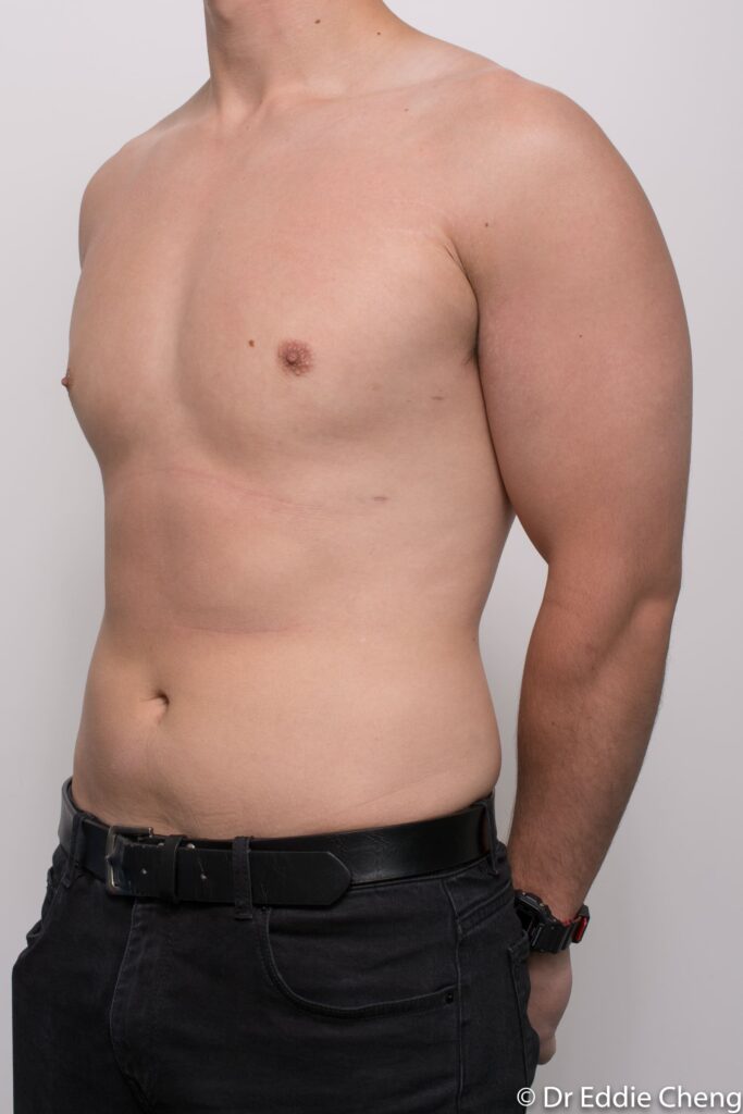 Before and after gynaecomastia surgery by Dr Eddie Cheng, Brisbane
