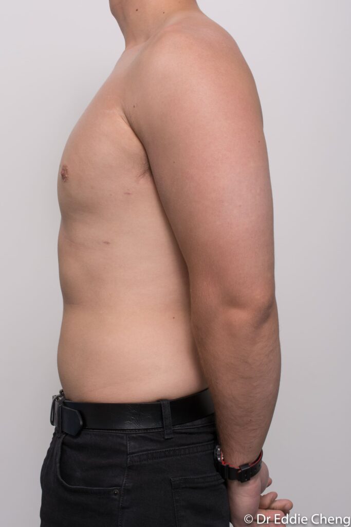 Before and after gynaecomastia surgery by Dr Eddie Cheng, Brisbane