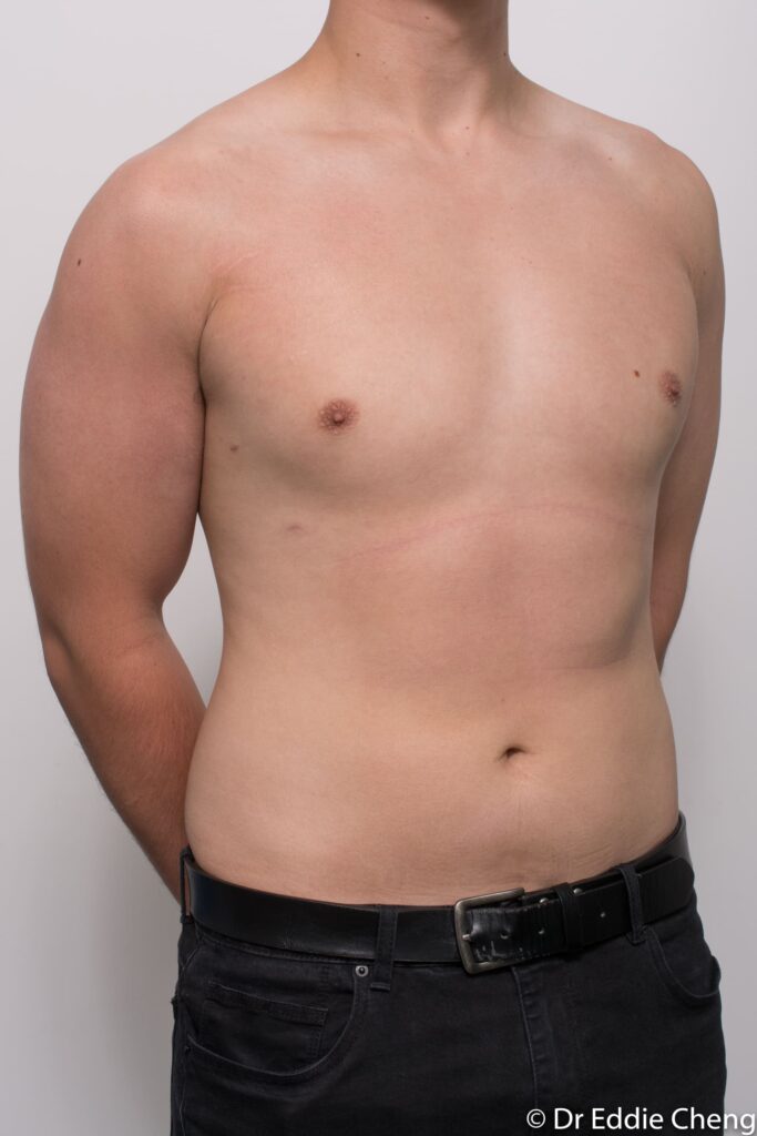 Before and after gynaecomastia surgery by Dr Eddie Cheng, Brisbane