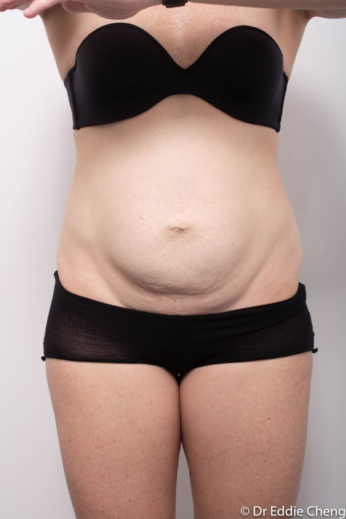 Before and after Abdominoplasty by Dr Eddie Cheng, Brisbane