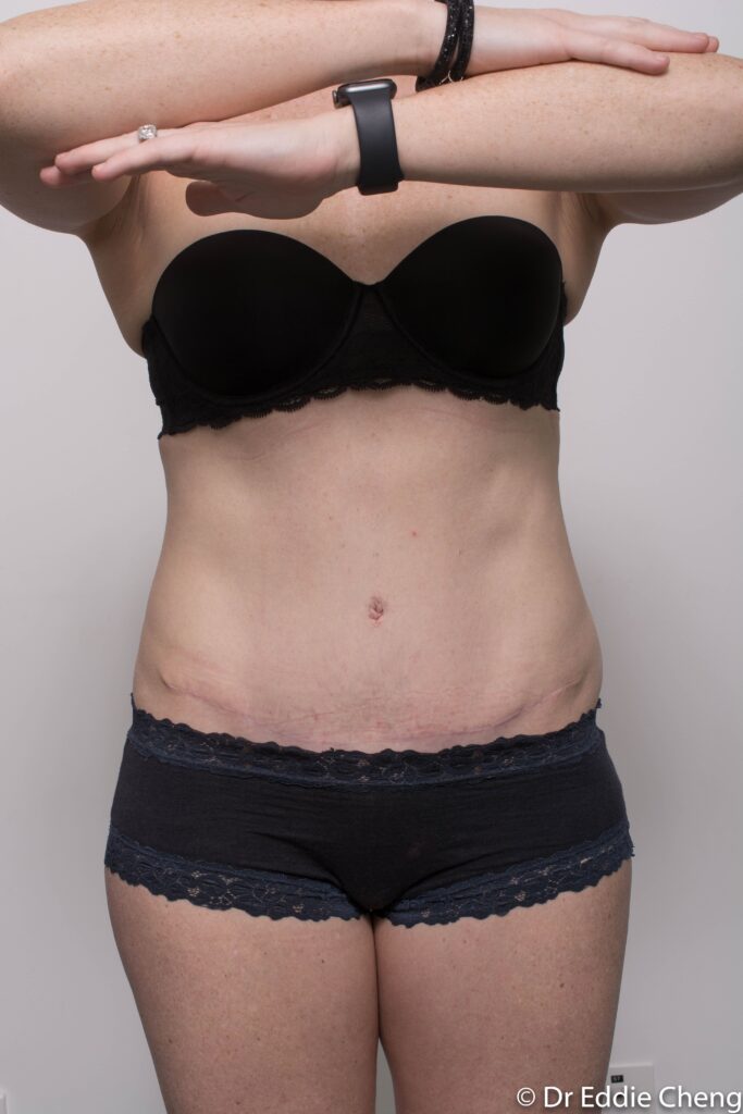 Before and after Abdominoplasty by Dr Eddie Cheng, Brisbane