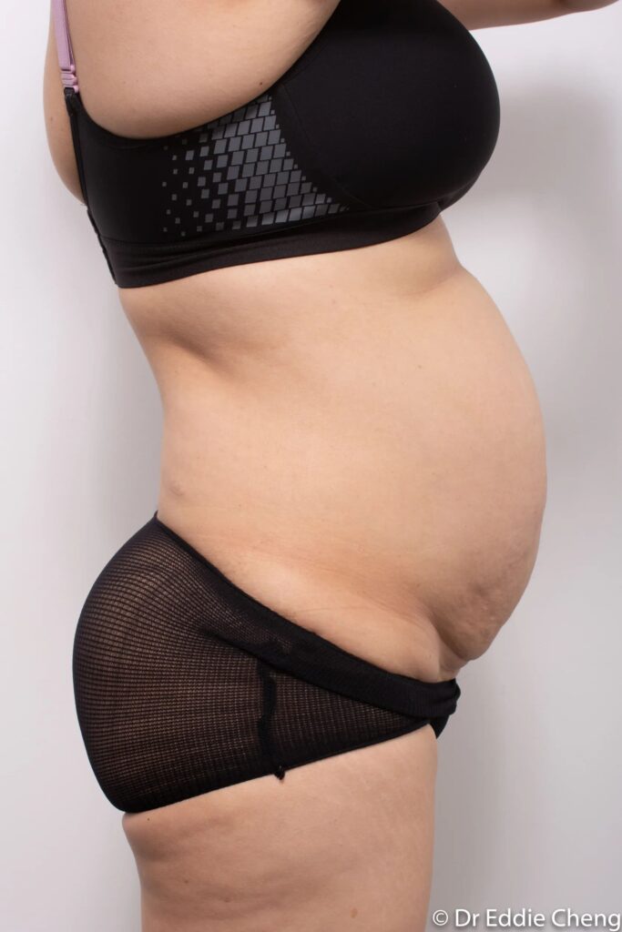 Before and after Abdominoplasty by Dr Eddie Cheng, Brisbane