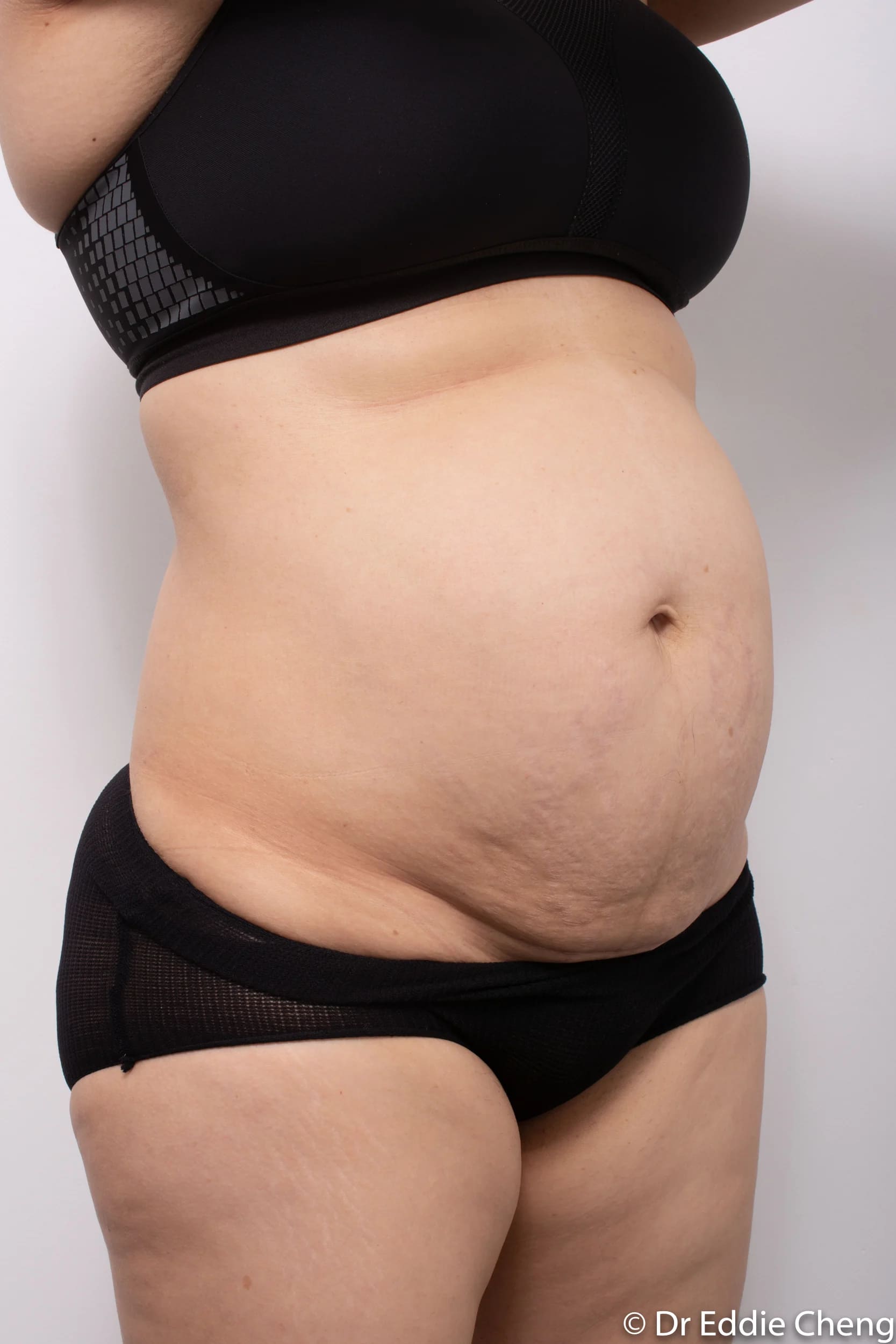 Before and after Abdominoplasty by Dr Eddie Cheng, Brisbane