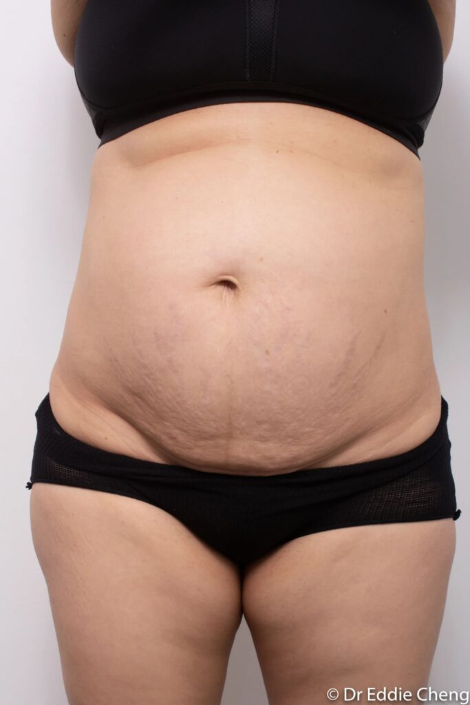 Before and after Abdominoplasty by Dr Eddie Cheng, Brisbane