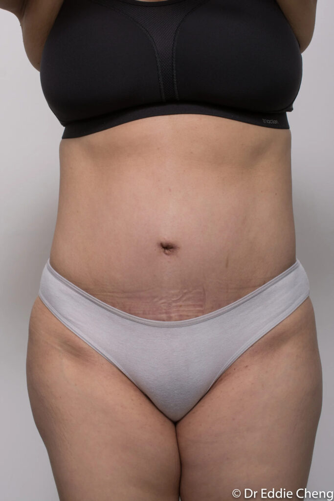 Before and after Abdominoplasty by Dr Eddie Cheng, Brisbane