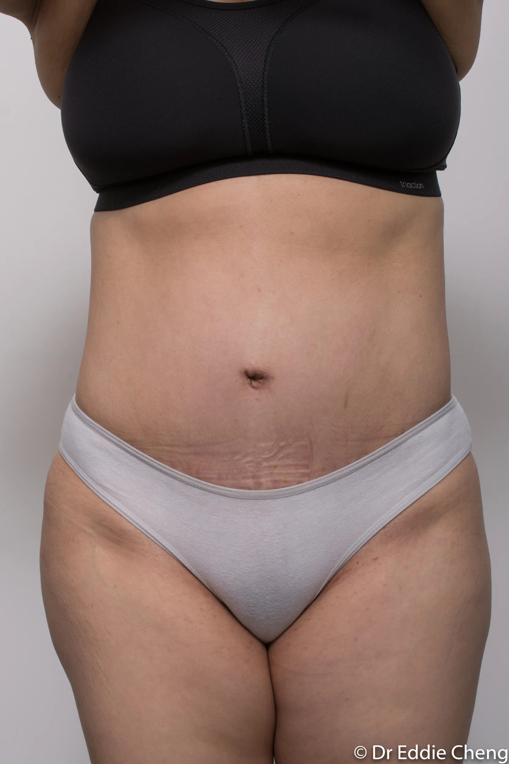 Before and after Abdominoplasty by Dr Eddie Cheng, Brisbane