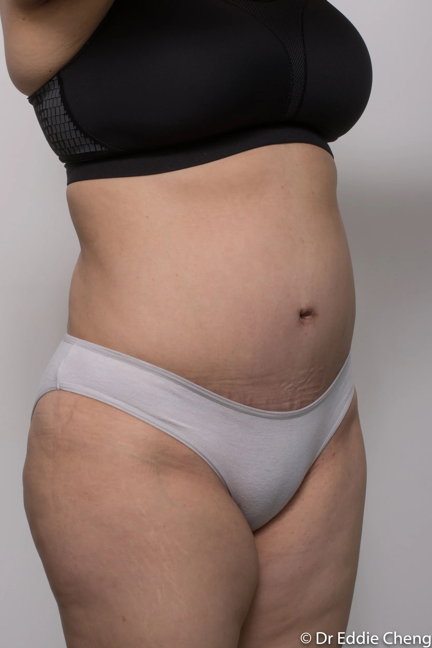 Before and after Abdominoplasty by Dr Eddie Cheng, Brisbane