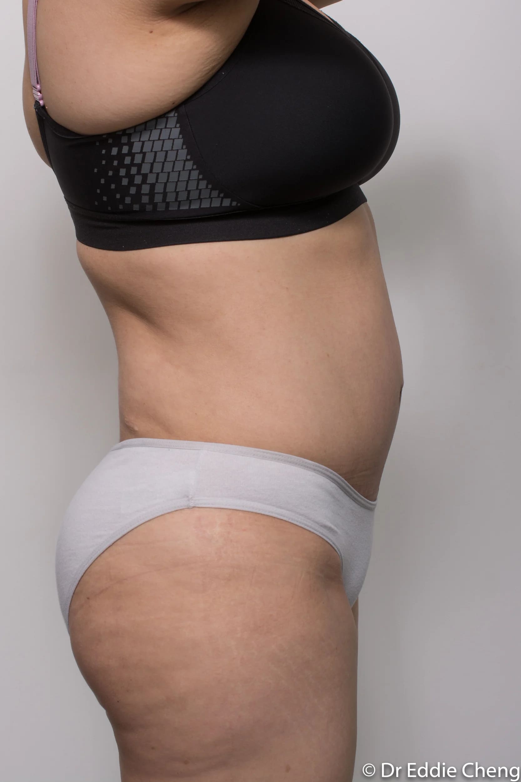 Before and after Abdominoplasty by Dr Eddie Cheng, Brisbane