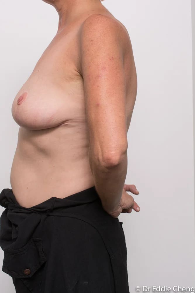 Before and after breast augmentation by Dr Eddie Cheng, Brisbane