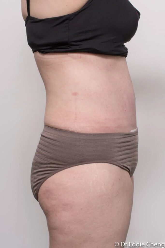 Before and after Abdominoplasty by Dr Eddie Cheng, Brisbane
