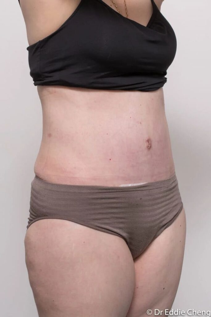 Before and after Abdominoplasty by Dr Eddie Cheng, Brisbane