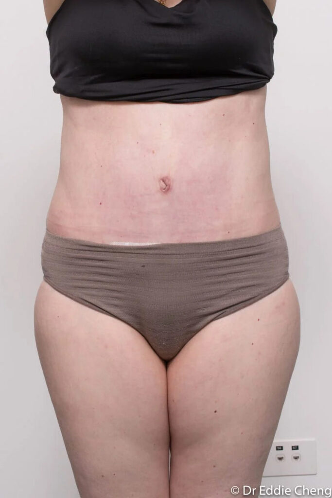 Before and after Abdominoplasty by Dr Eddie Cheng, Brisbane