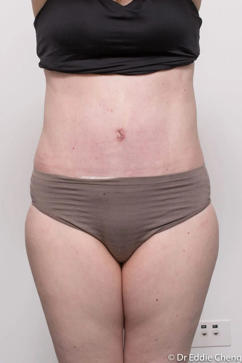 Before and after Abdominoplasty by Dr Eddie Cheng, Brisbane