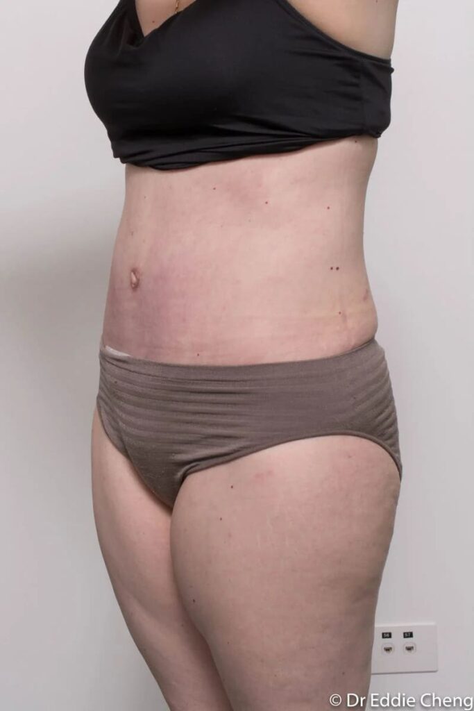 Before and after Abdominoplasty by Dr Eddie Cheng, Brisbane