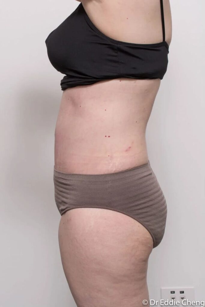 Before and after Abdominoplasty by Dr Eddie Cheng, Brisbane