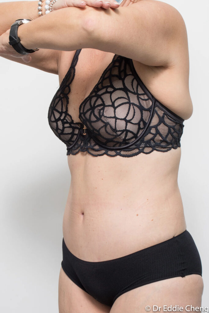Before and after abdominoplasty by Dr Eddie Cheng, Brisbane