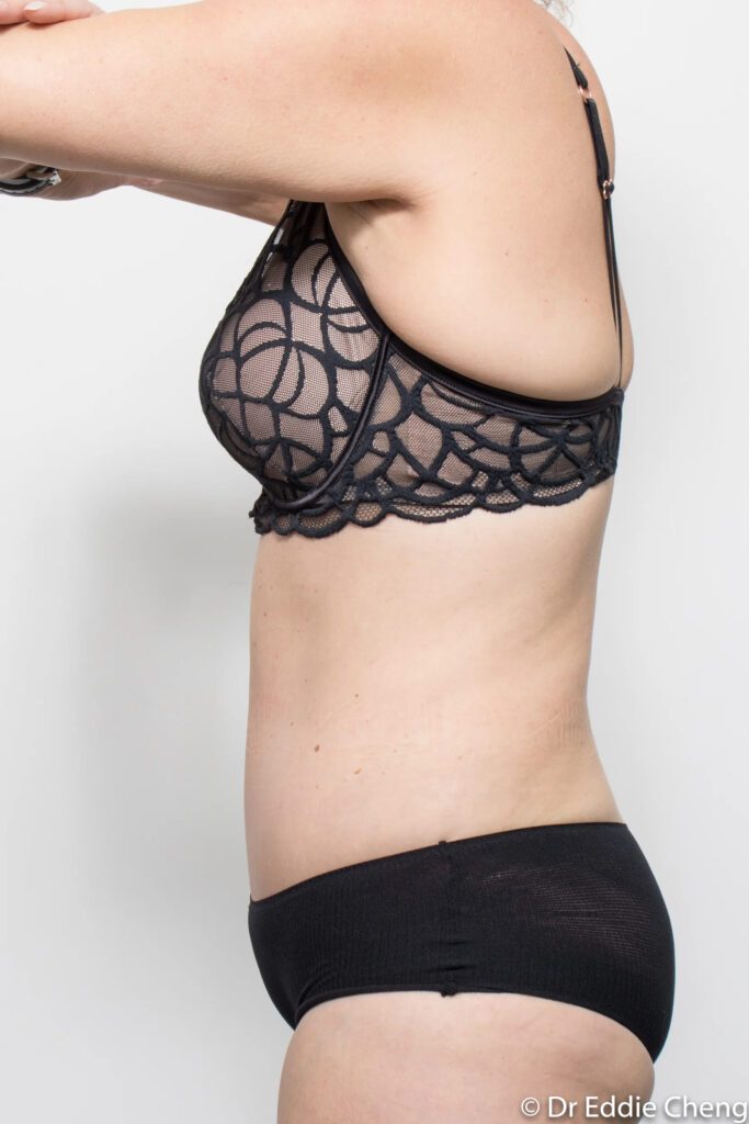 Before and after abdominoplasty by Dr Eddie Cheng, Brisbane