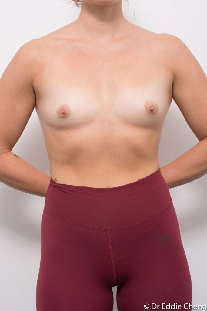 Before and after breast augmentation surgery by Dr Eddie Cheng, Brisbane
