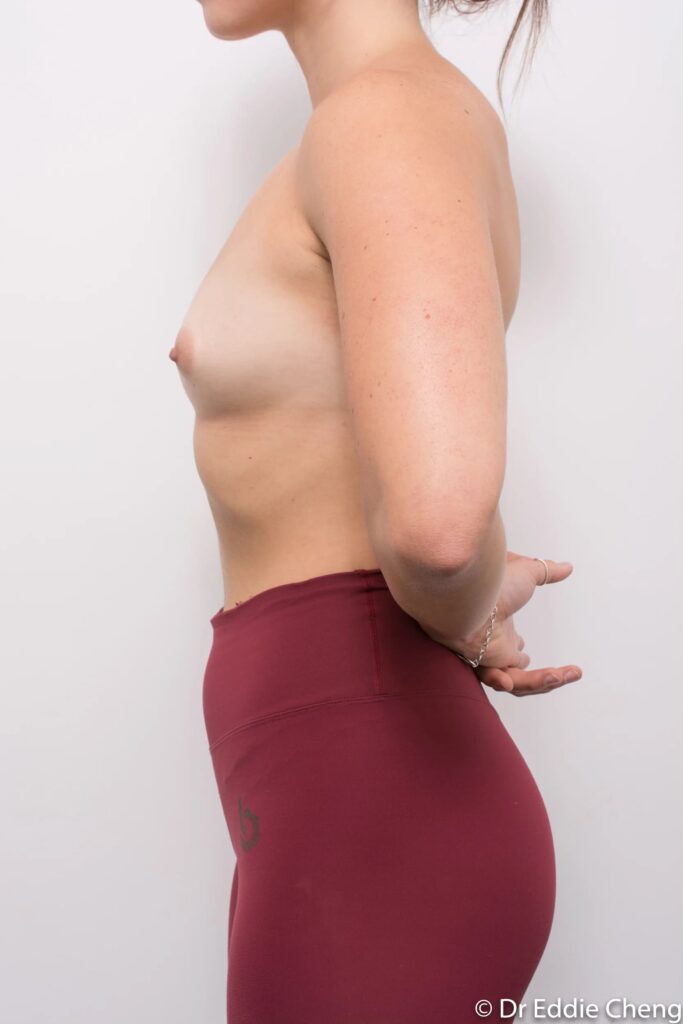 Before and after breast augmentation surgery by Dr Eddie Cheng, Brisbane