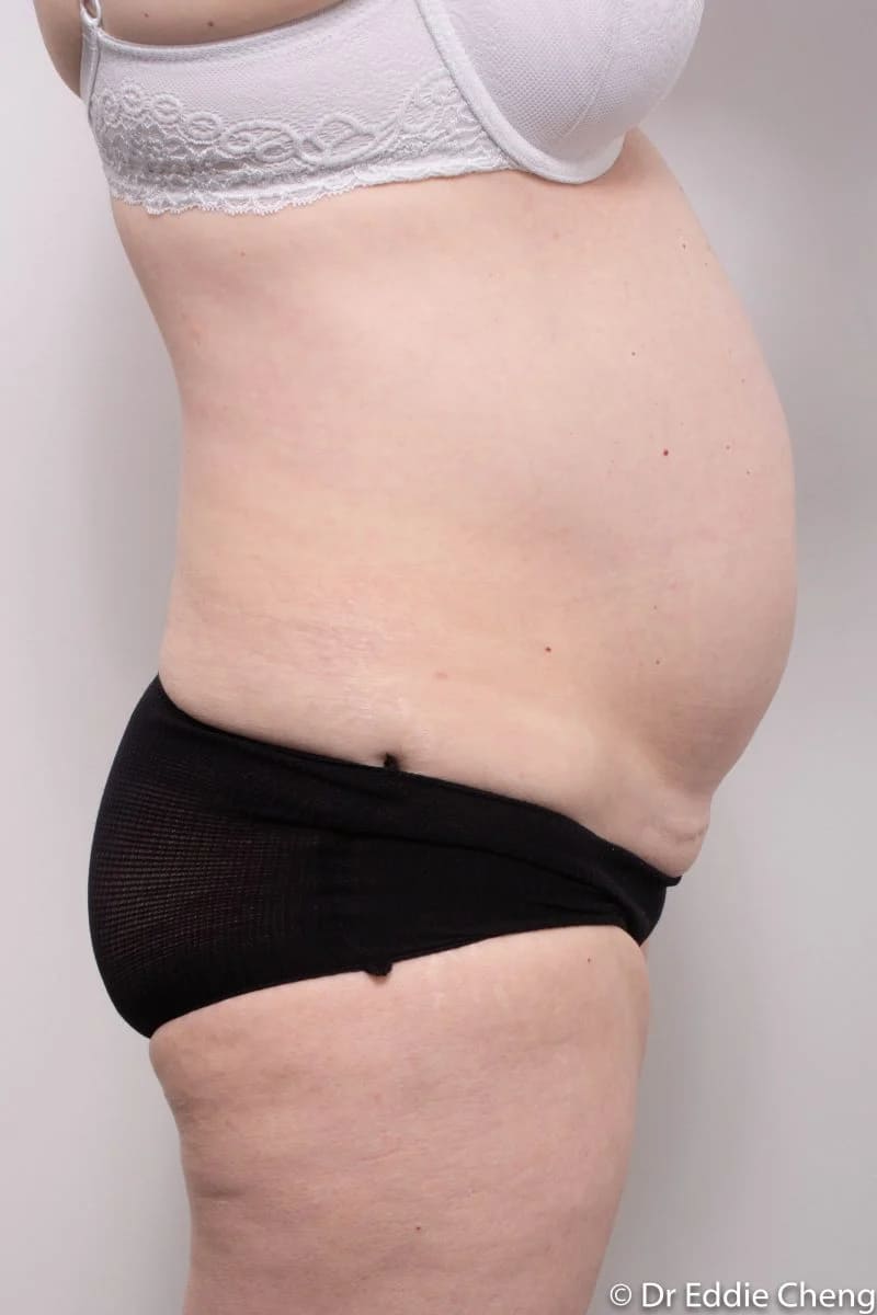 Before and after Abdominoplasty by Dr Eddie Cheng, Brisbane