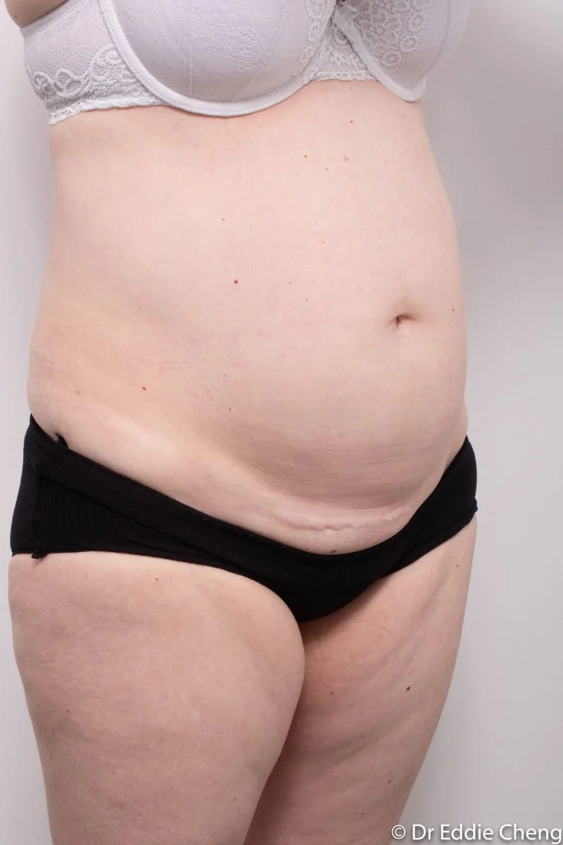 Before and after Abdominoplasty by Dr Eddie Cheng, Brisbane