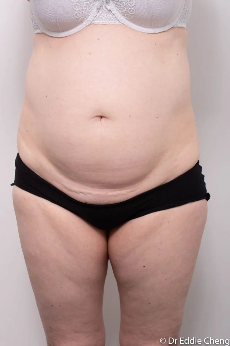 Before and after Abdominoplasty by Dr Eddie Cheng, Brisbane