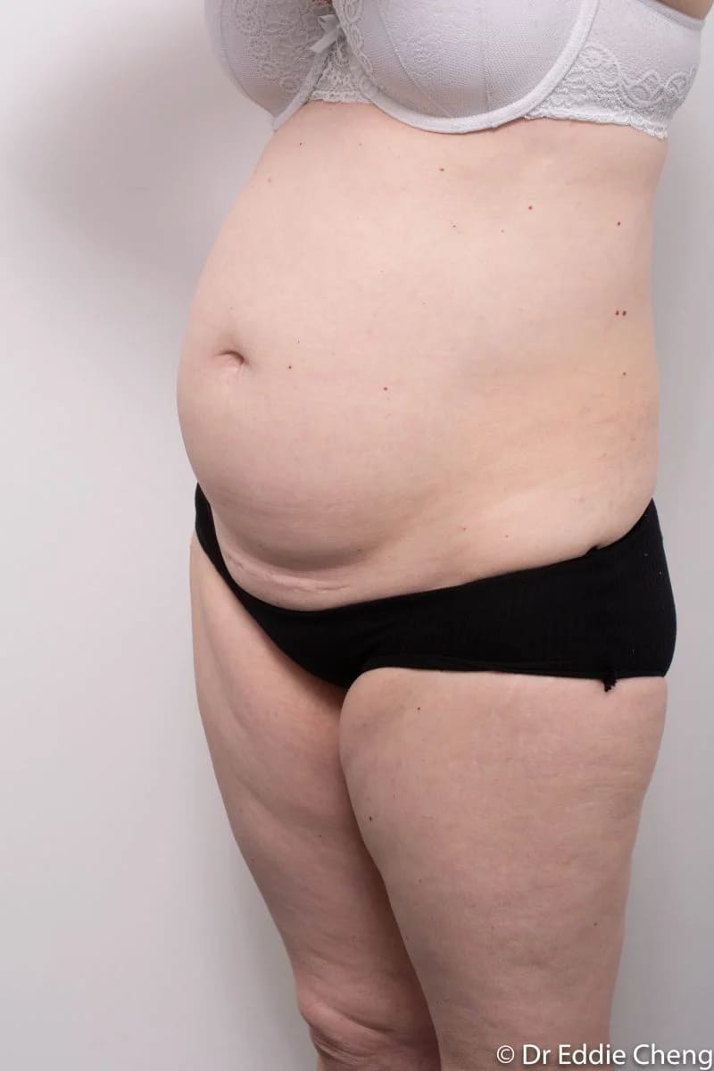 Before and after Abdominoplasty by Dr Eddie Cheng, Brisbane