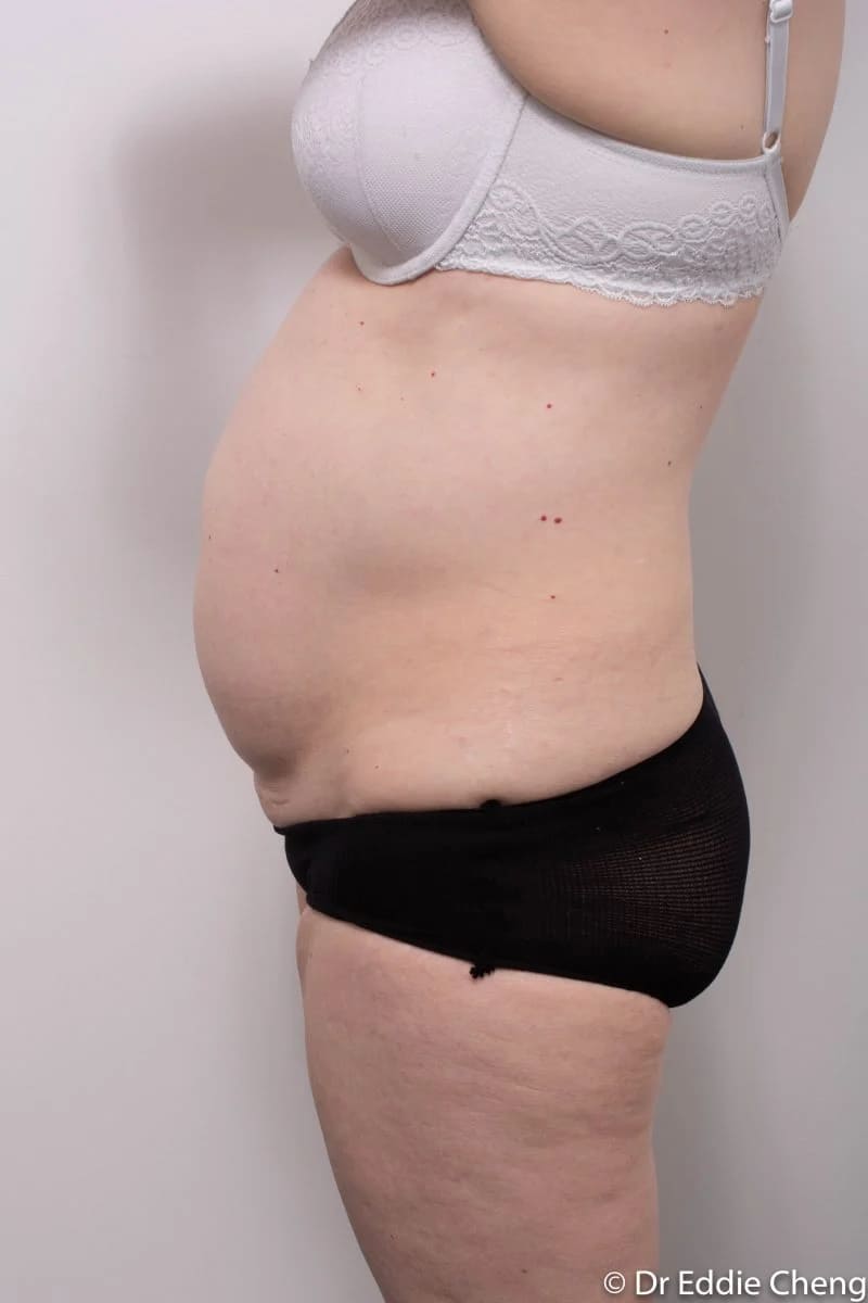 Before and after Abdominoplasty by Dr Eddie Cheng, Brisbane