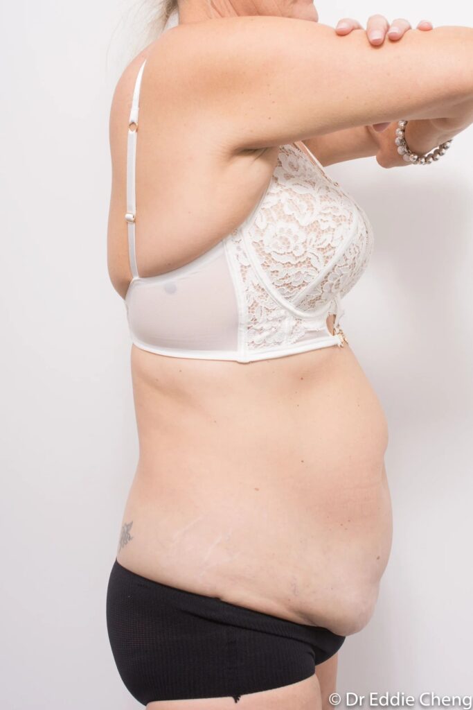 Before and after abdominoplasty by Dr Eddie Cheng, Brisbane