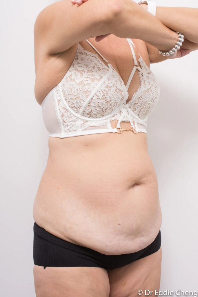 Before and after abdominoplasty by Dr Eddie Cheng, Brisbane
