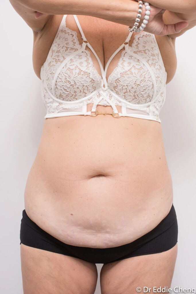 Before and after abdominoplasty by Dr Eddie Cheng, Brisbane