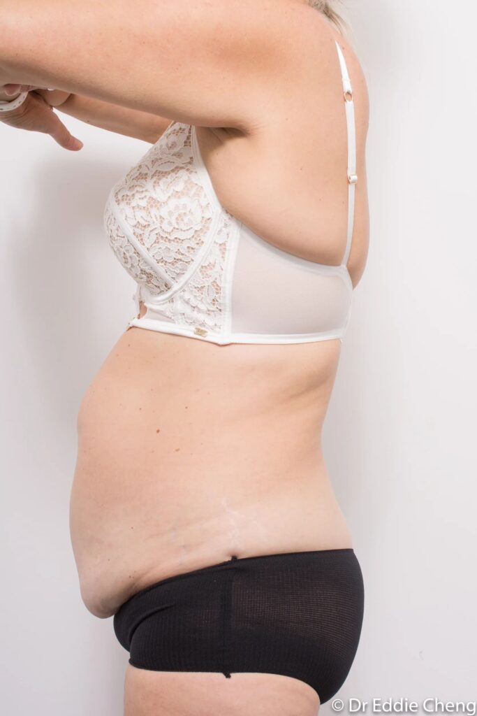 Before and after abdominoplasty by Dr Eddie Cheng, Brisbane