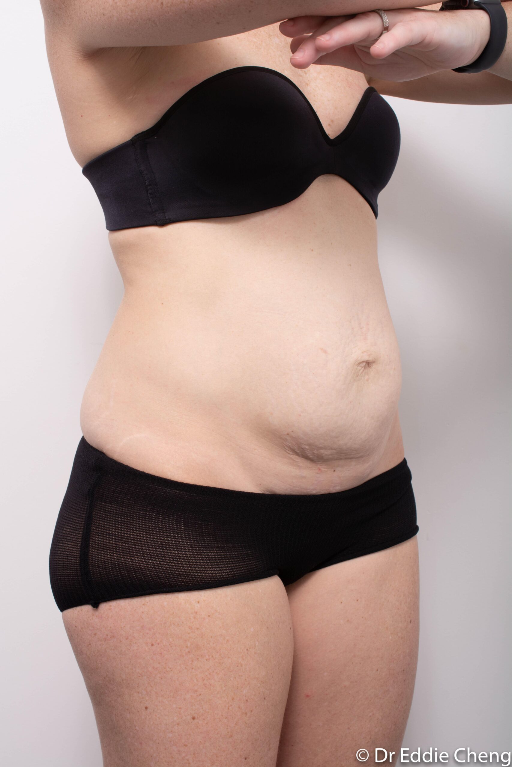 Before and after Abdominoplasty by Dr Eddie Cheng, Brisbane
