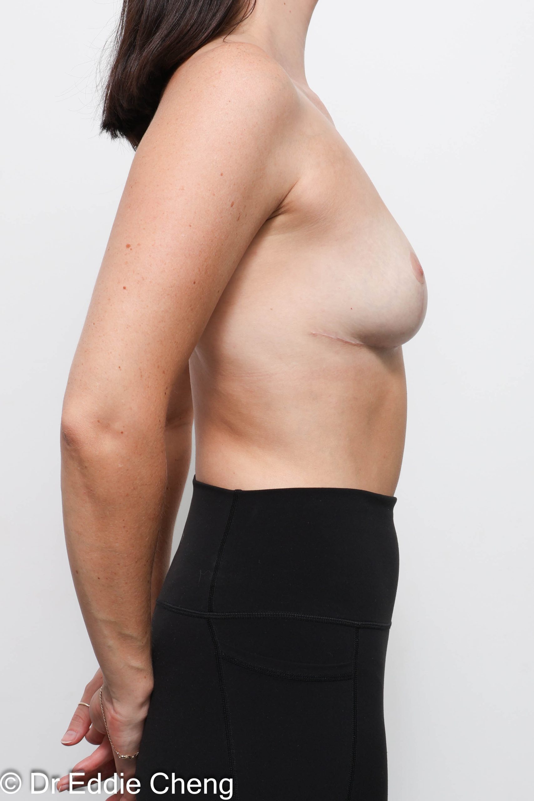 Patient results of breast augmentation by Brisbane specialist Dr Eddie Cheng