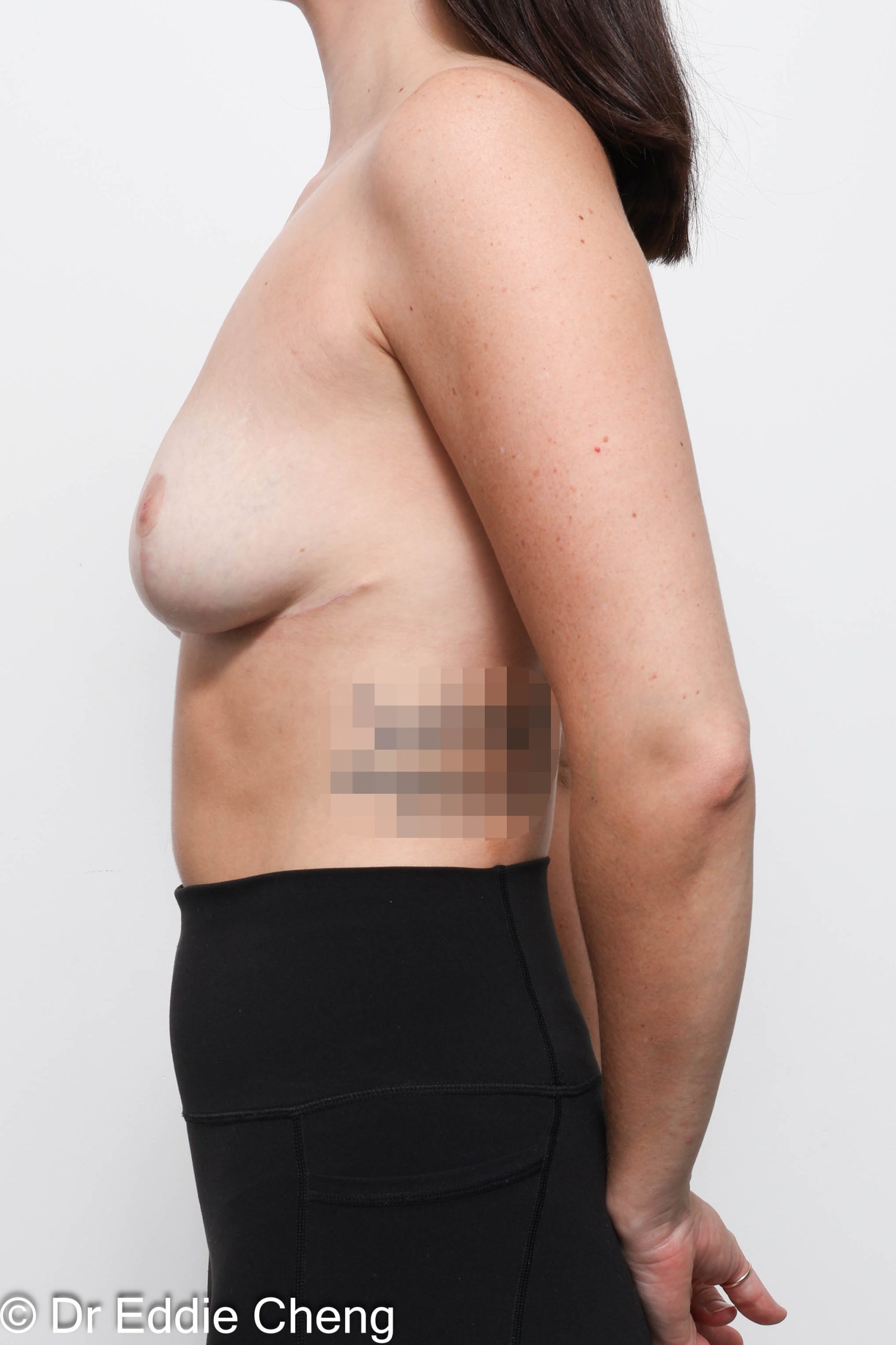 Patient results of breast augmentation by Brisbane specialist Dr Eddie Cheng