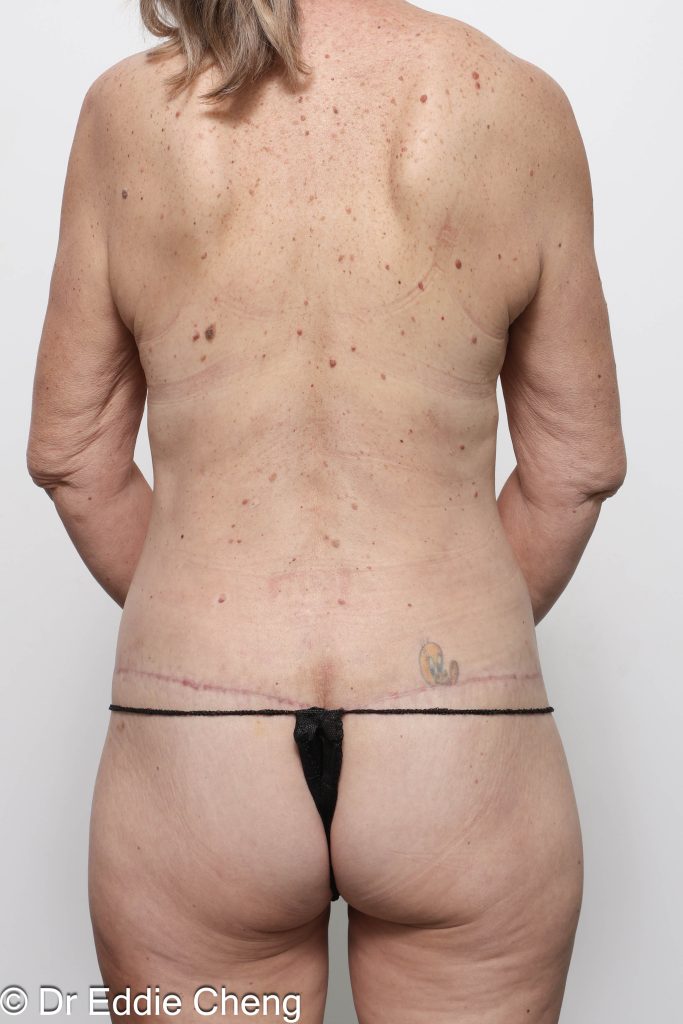 Before and after circumferential lipectomy surgery by Dr Eddie Cheng, AR Plastic Surgery Brisbane