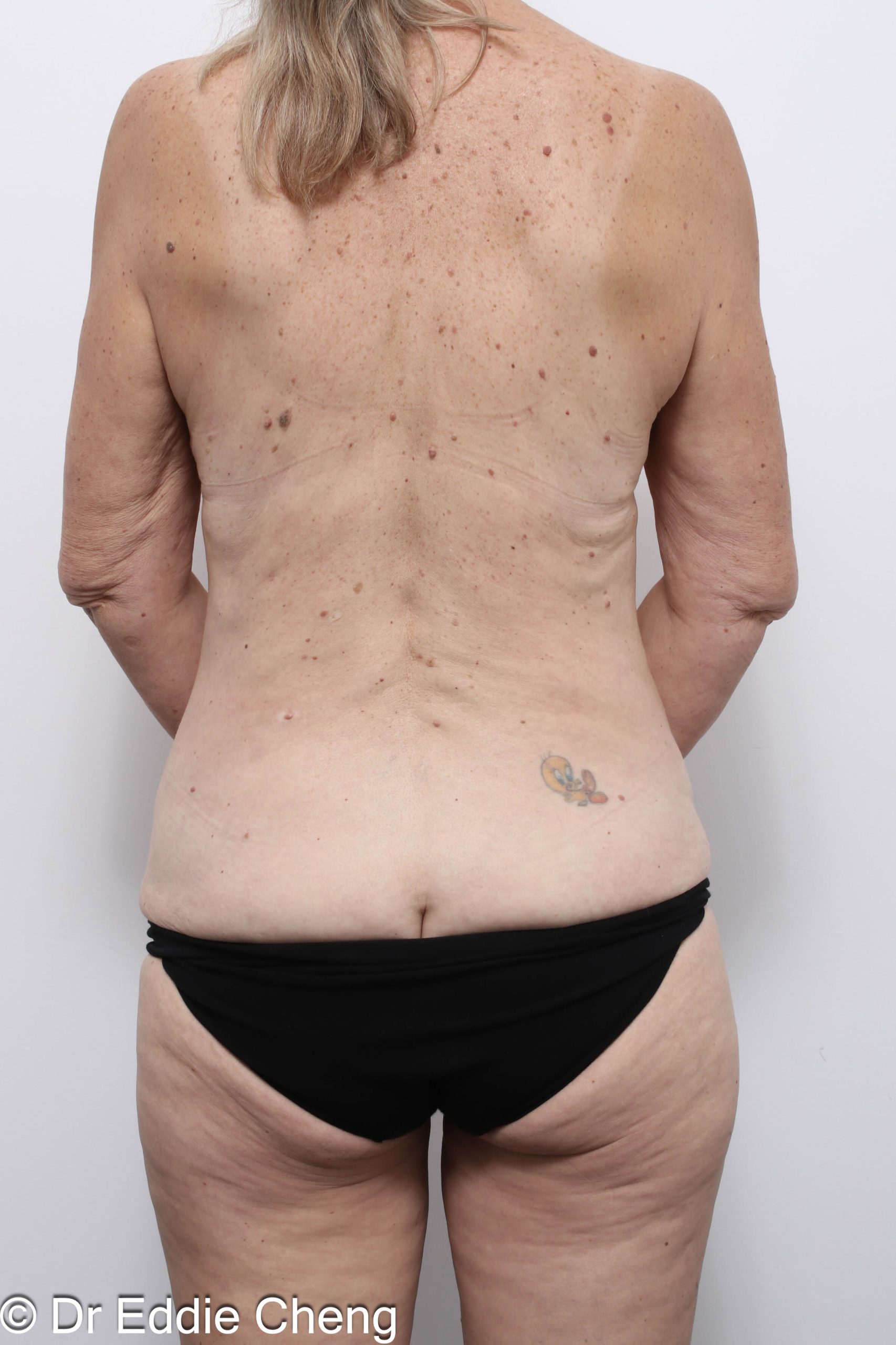 Before and after circumferential lipectomy surgery by Dr Eddie Cheng, AR Plastic Surgery Brisbane