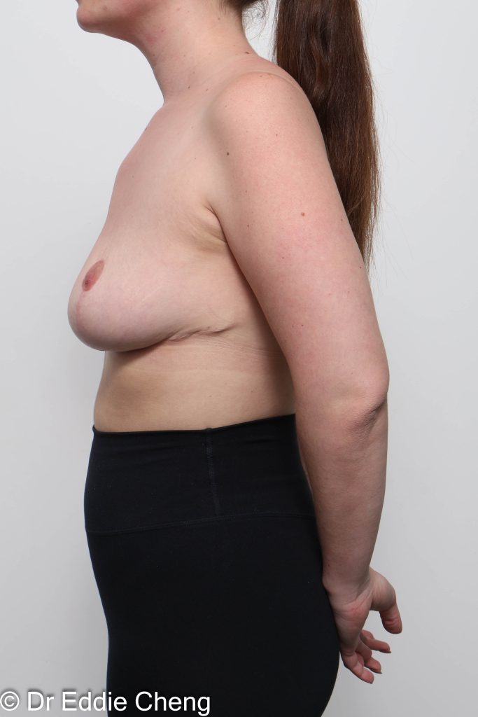 Before and after breast reduction surgery by Dr Eddie Cheng, AR Plastic Surgery Brisbane