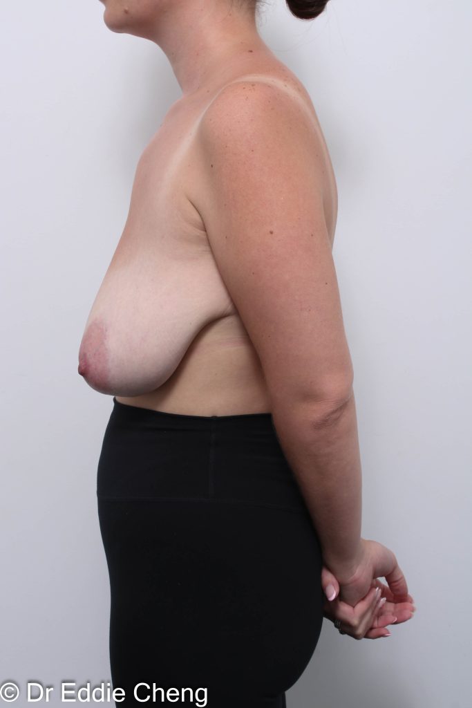 Before and after breast reduction surgery by Dr Eddie Cheng, AR Plastic Surgery Brisbane