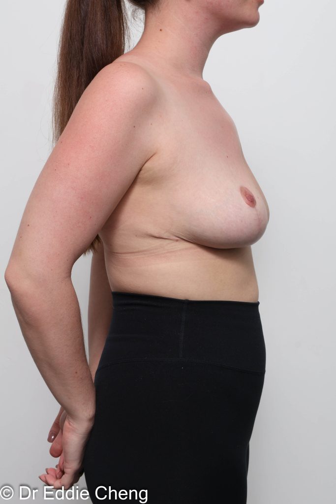 Before and after breast reduction surgery by Dr Eddie Cheng, AR Plastic Surgery Brisbane